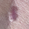 SKIN:  Basal Cell Carcinoma  — BCC  (Video)