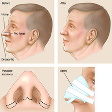 Rhinoplasty Singapore