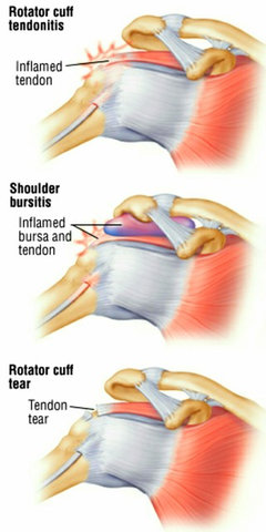 rotator cuff syndrome treatment