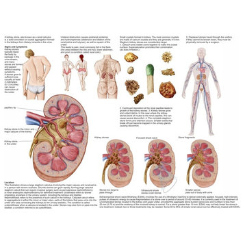 Medical Chart Showing The Signs And Symptoms Of Kidney Stones. Print