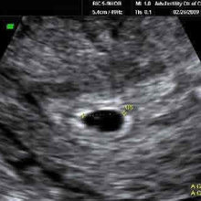 Pregnancy
