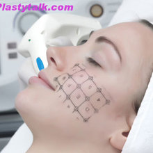 Thermage Treatment in Singapore