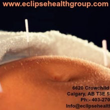 Why Fertility Acupuncture in Calgary Is the Best Option to Treat Infert