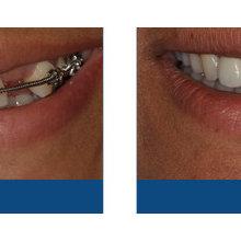 Marchack Implant work