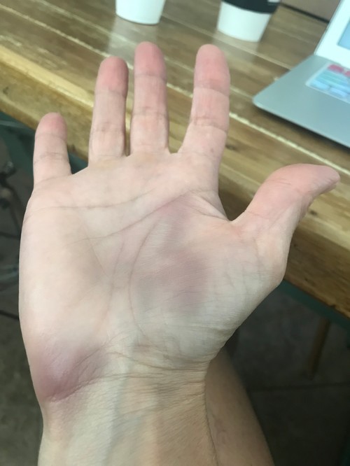 blueness in the thumb muscle Blueness in the thumb muscle