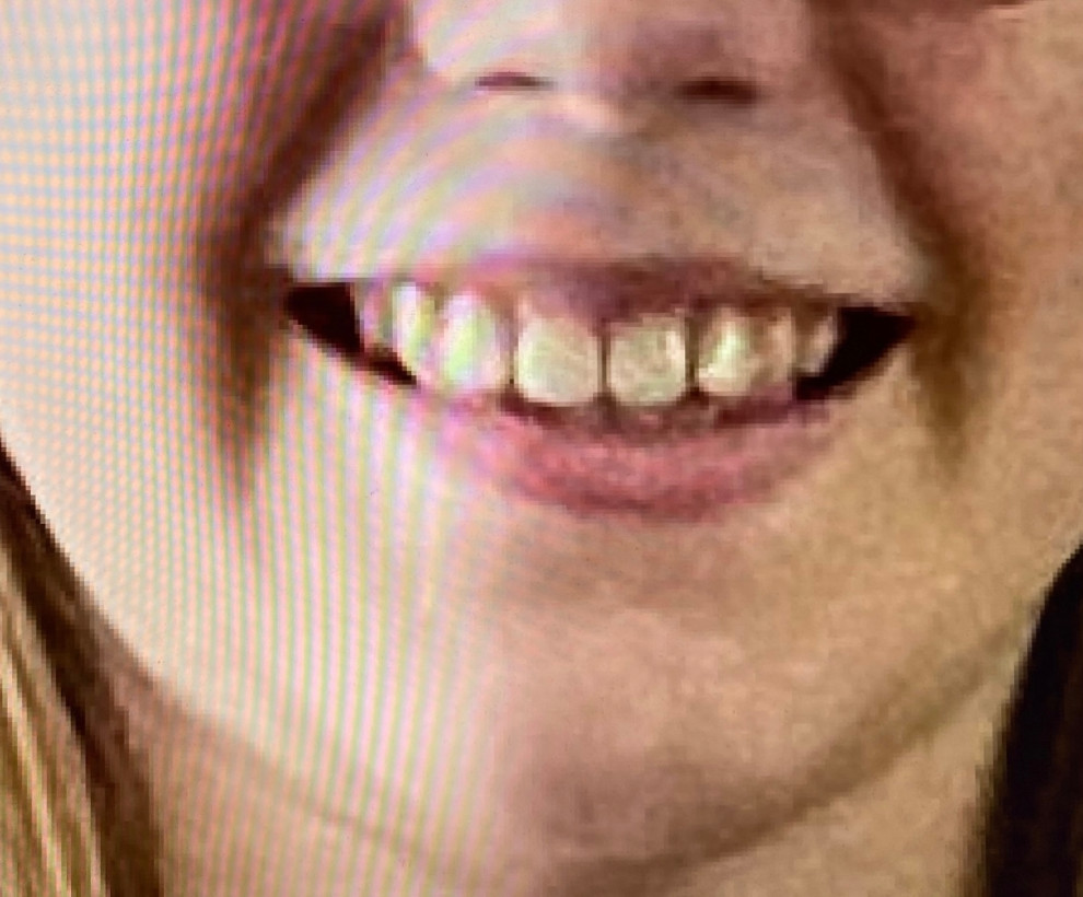 Braces versus Invisalign for 12 year old